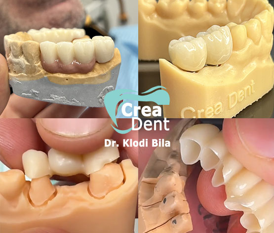 ponti-corone-in-zirconio-su-impianti-dentali