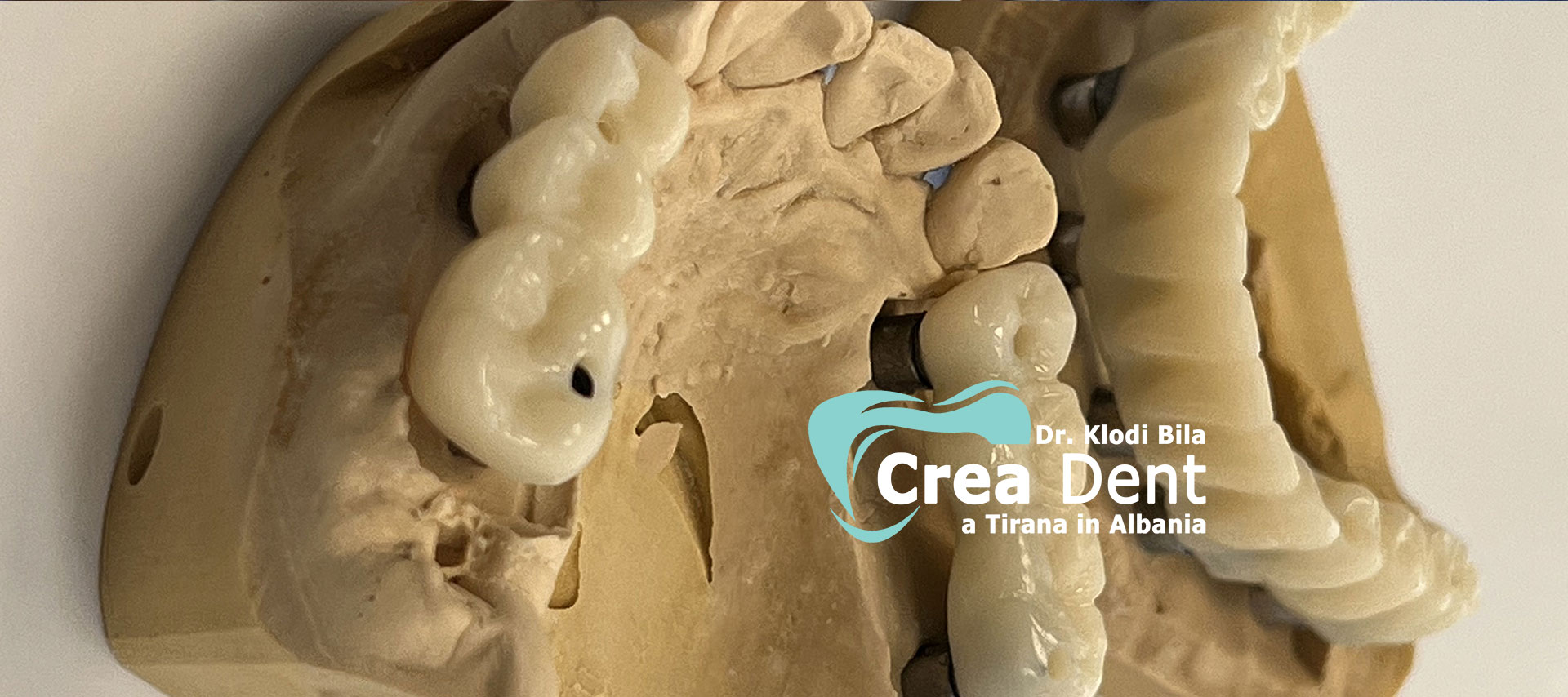 paziente-del-turismo-dentale-in-albania-della-clinica-crea-dent.